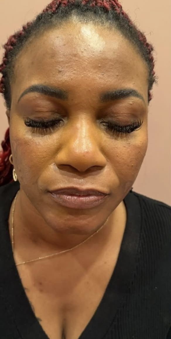 Smile line before treatment